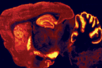 Smoking marijuana can be addictive. THC attaches to receptors in the brain (bright yellow and orange) and impacts learning, memory and coordination.